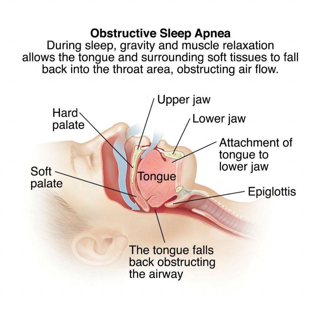The Health Risks of Sleep Apnea - Fawcett Mattress