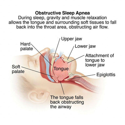 The Health Risks of Sleep Apnea